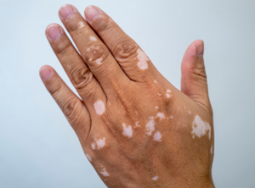 白癜风并发症揭秘：这些风险你可能不知道！