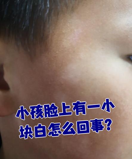 [新趋势]泉州正式白癜风治疗医院？小孩脸上白斑摸上去粗糙？