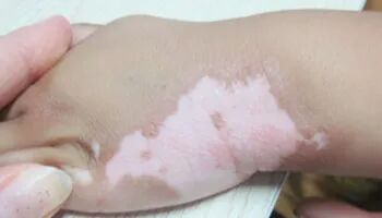 小面积白斑别摆烂！从伍德灯到皮肤CT：在泉州中科如何实现白癜风的精准诊断与防复发！